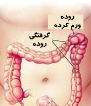 بیماری روده تحریک پذیر چیست؟
